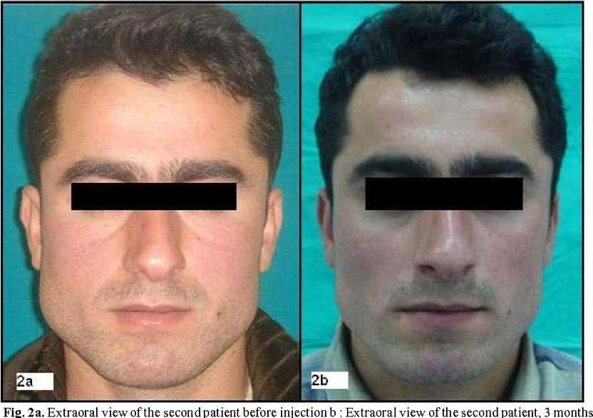 Extraoral view of the second patient before botox injection vs. 3 months after injection