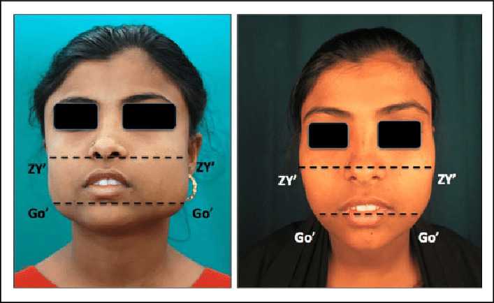 Preoperative and postoperative frontal profile of a patient undergoing debulking surgery